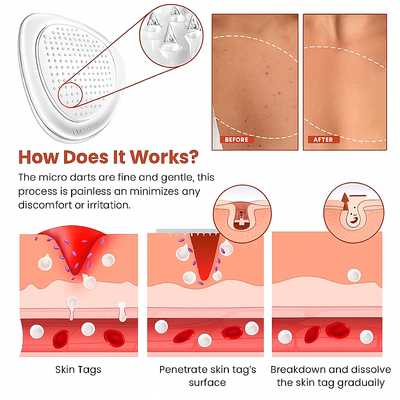 Derma Smooth Skin Tag Removal Patch