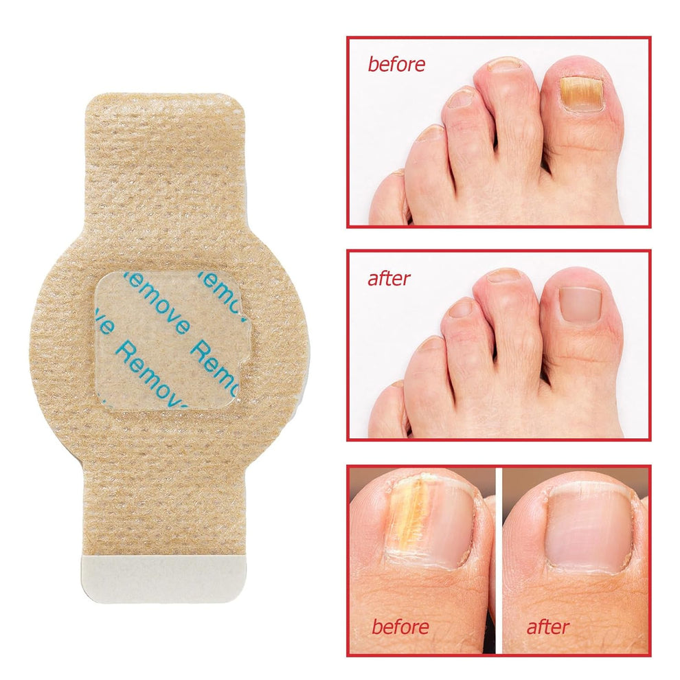 NailHeal™ - Fungal Nail Patches 🌿 ( Buy 1 Get 1 Free🔥)