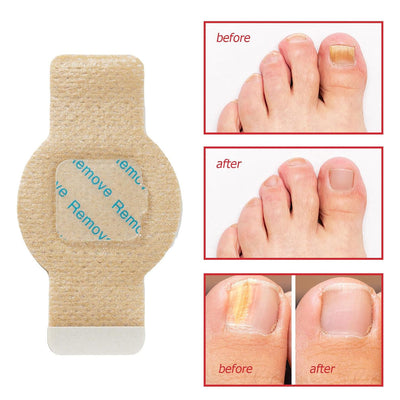NailHeal™ - Fungal Nail Patches 🌿 ( Buy 1 Get 1 Free🔥)